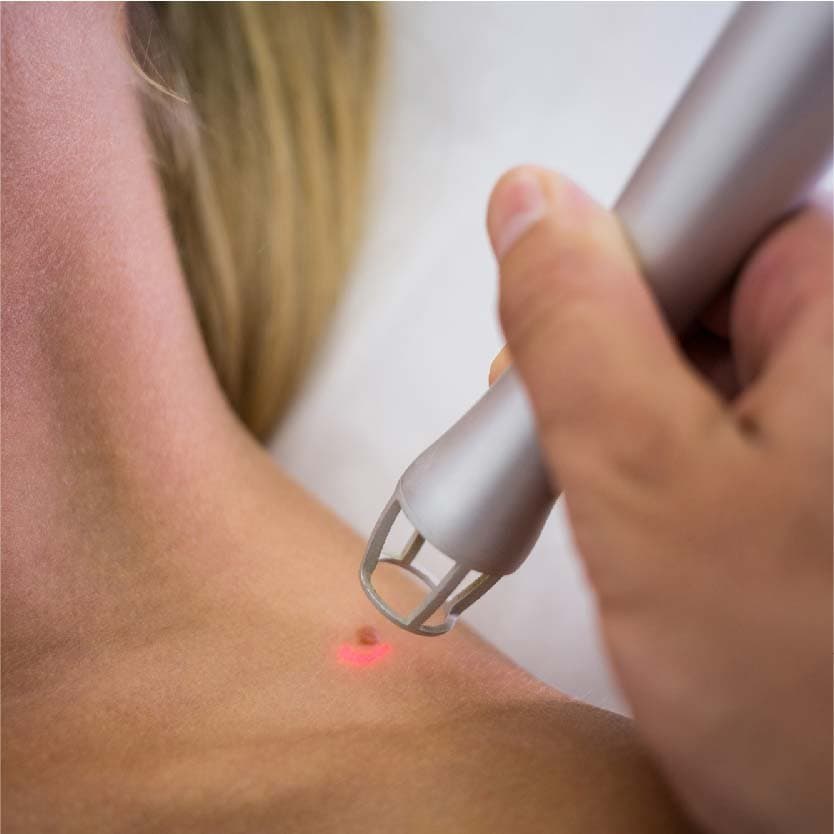 Surgical Removal of Moles