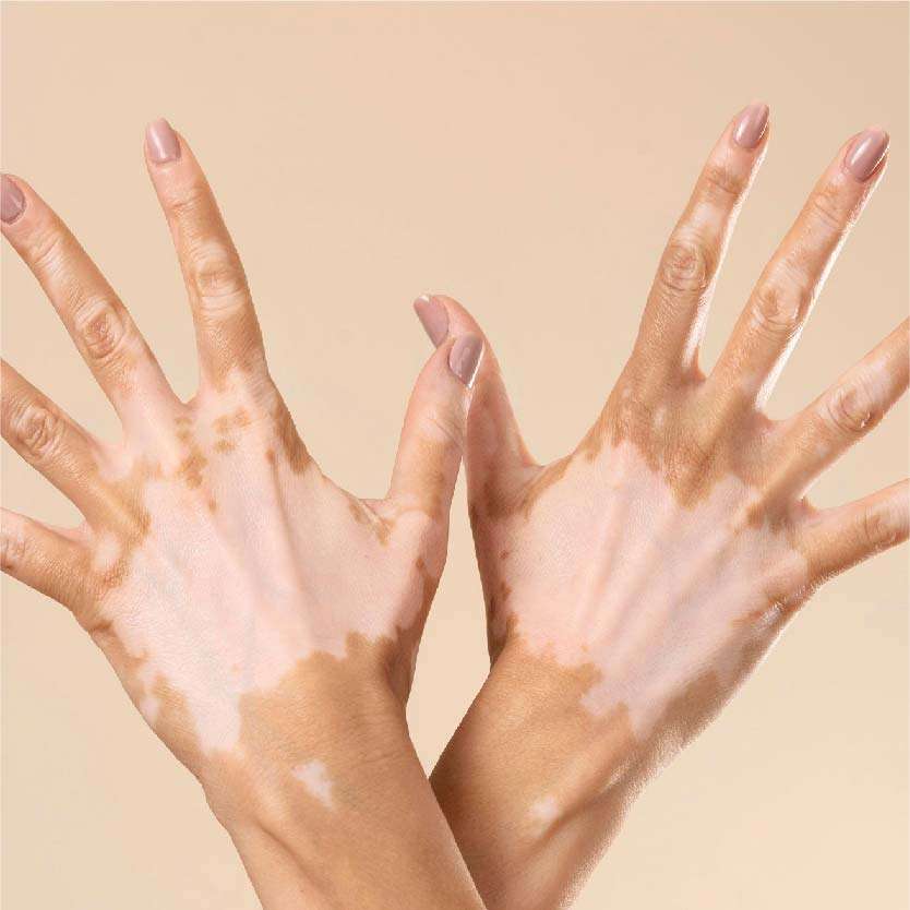 Vitiligo Surgery