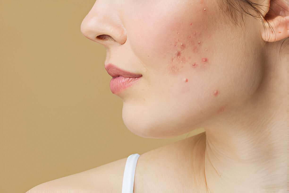 What Works & What Doesn’t for Acne-Prone Skin