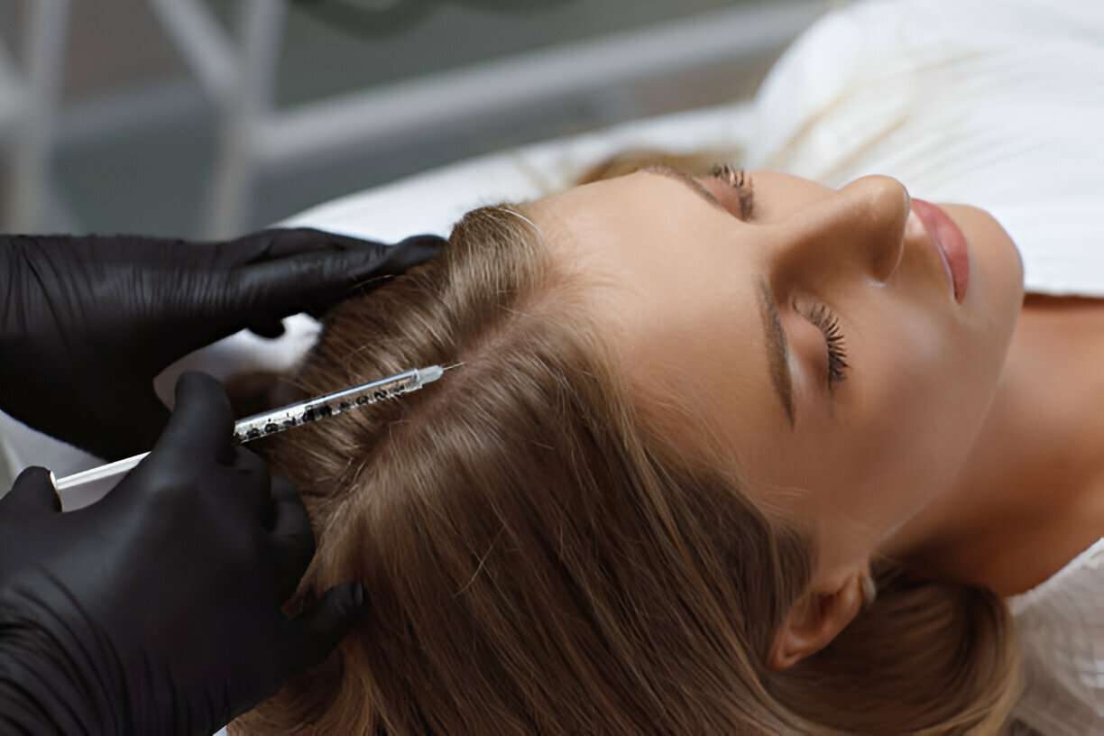PRP for Hair Growth – What to Expect